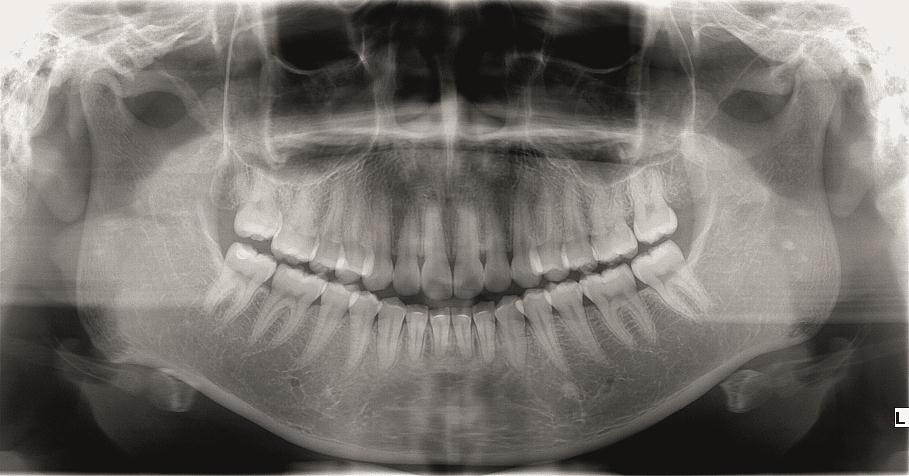 Nasal Polyps prevention with periodic Panoramic x-ray